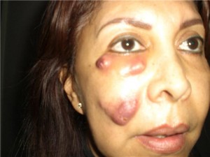 botched-botox-injections-gone-wrong-photo-300x225