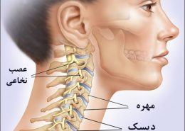 درمان دیسک گردن طب سنتی سوزنی زالو درمانی