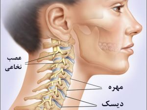 درمان دیسک گردن طب سنتی سوزنی زالو درمانی