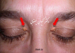 جوش های زرد در ناحیه پری اوربیتال چشم ها