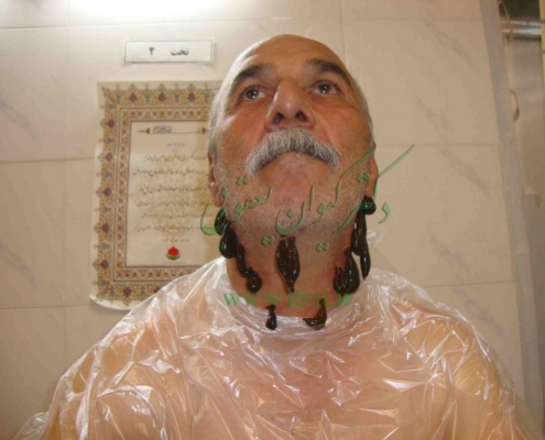 زالودرمانی گررفتگی عروق کاروتيد گردن بزاق زالو